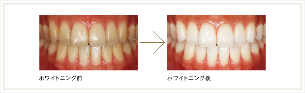 クリーニング術前術後